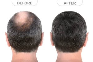 Understanding Hair Transplant Procedures
