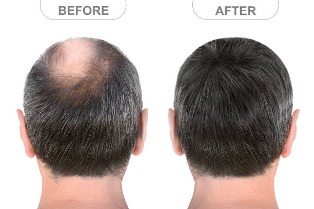 What's Finasteride 1 Understanding Hair Transplant Procedures