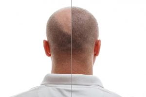 Overview of Hair Loss Treatments