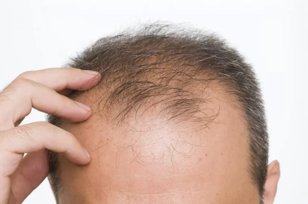 Cause ıf Hair Comparing Efficacy With Other Hair Loss Treatments
