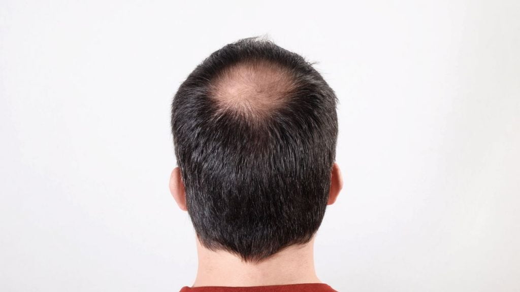 Hair Transplant
