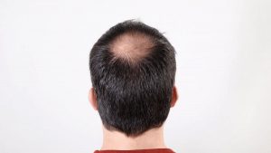 Hair Transplant