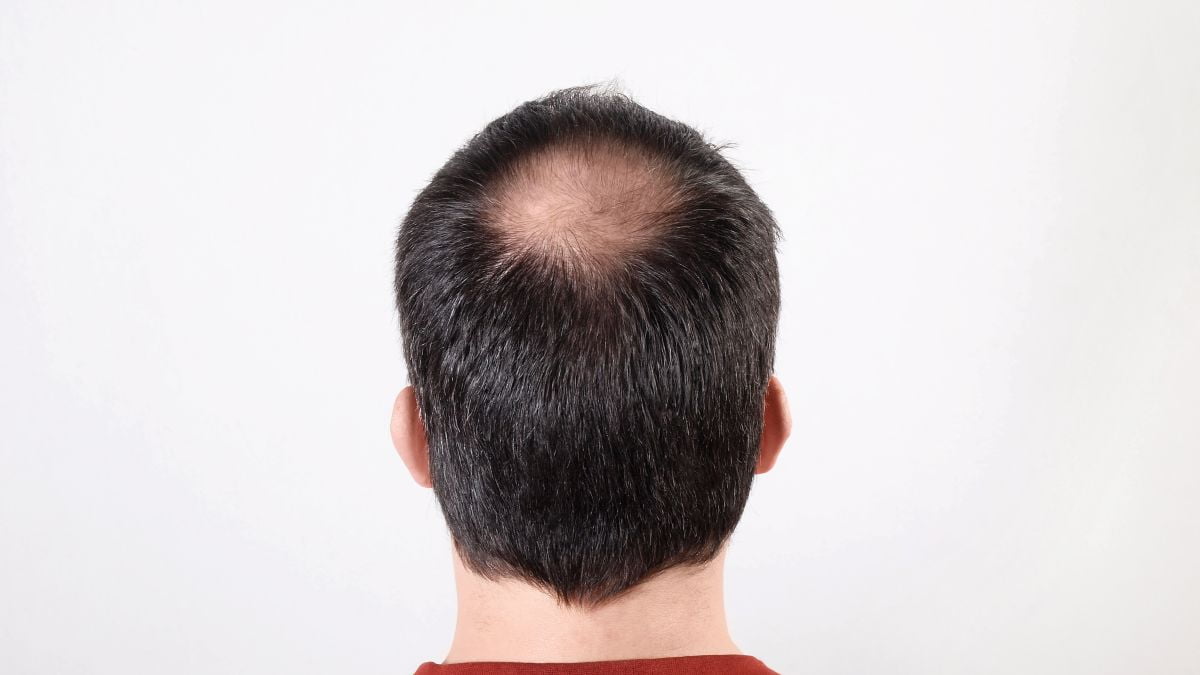 Hair Transplant