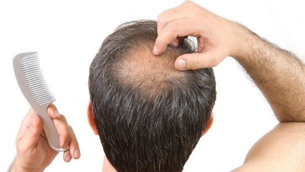 Hair Loss Treatment DHT and Hair Loss